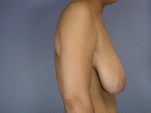 About The Stevens Laser Bra Breast Lift and Breast Reduction Surgery