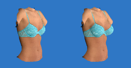 Los Angeles Laser Bra Before and After Photos - Marina Del Rey